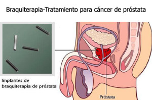 Braquiterapia-Tratamiento-Cancer-Prostata